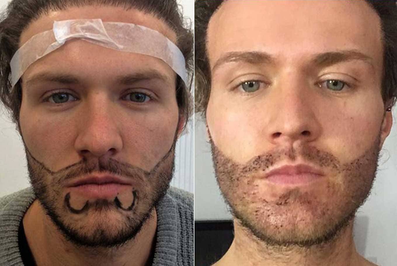 Сколько длится пересадка. Трансплантация бороды. Наращивание бороды до и после. Мужская растительность на лице.